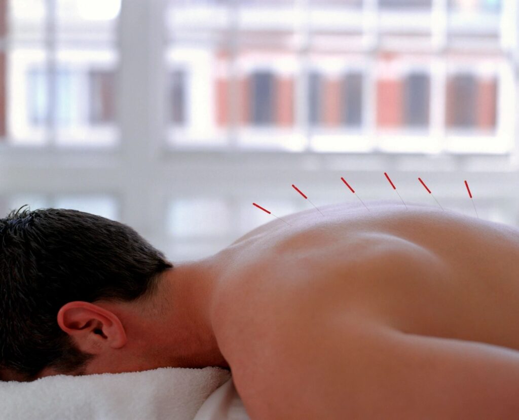 Person receiving Acupuncture treatment